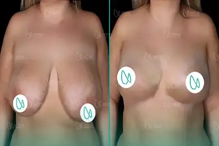 Before-After Combined
