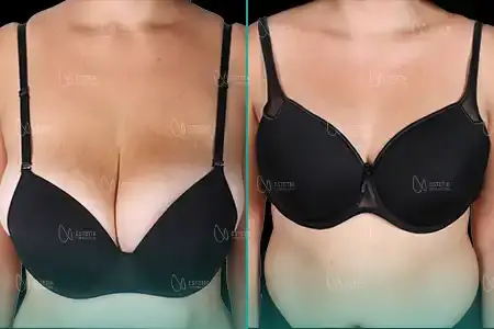Before-After Combined