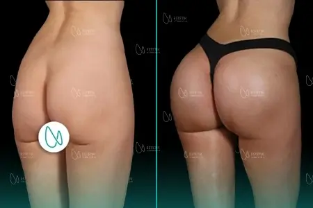 Before-After Combined