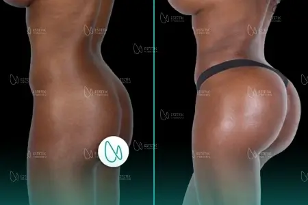 Before-After Combined