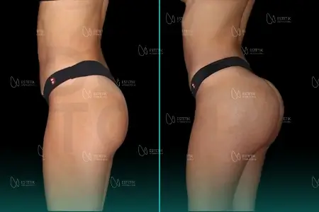 Before-After Combined