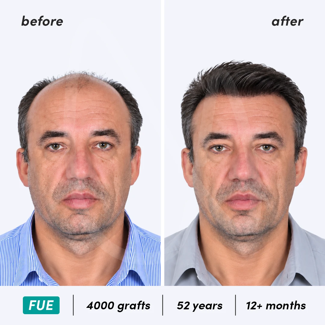 Before-After Combined