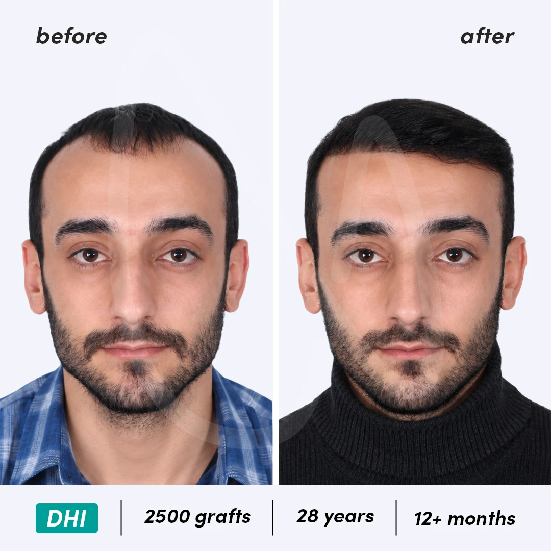 Before-After Combined