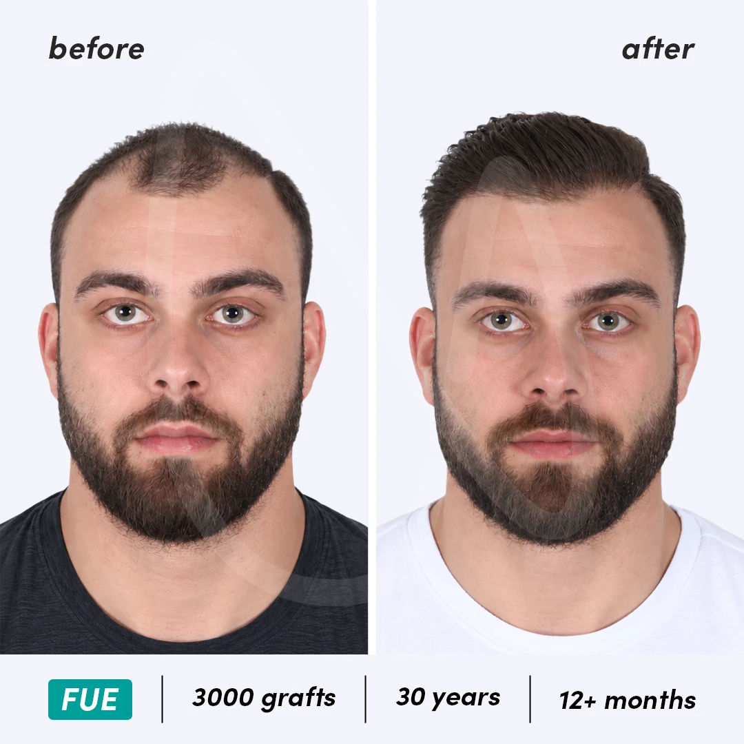 Before-After Combined