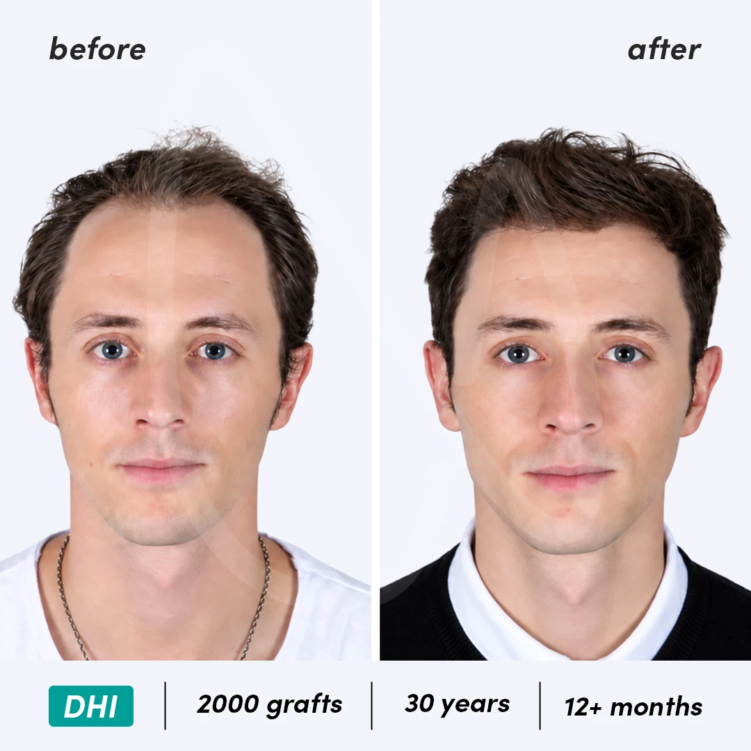 Before-After Combined