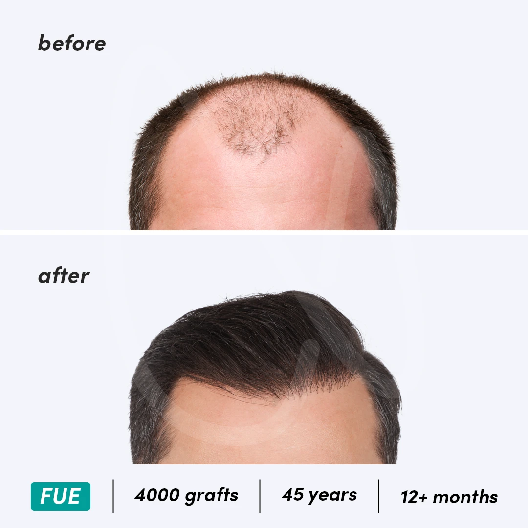 Before-After Combined
