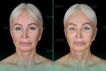 Before-After Combined