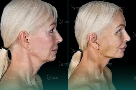 Before-After Combined