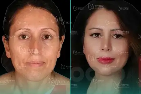 Before-After Combined