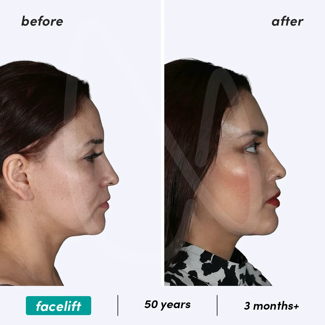 Before-After Combined