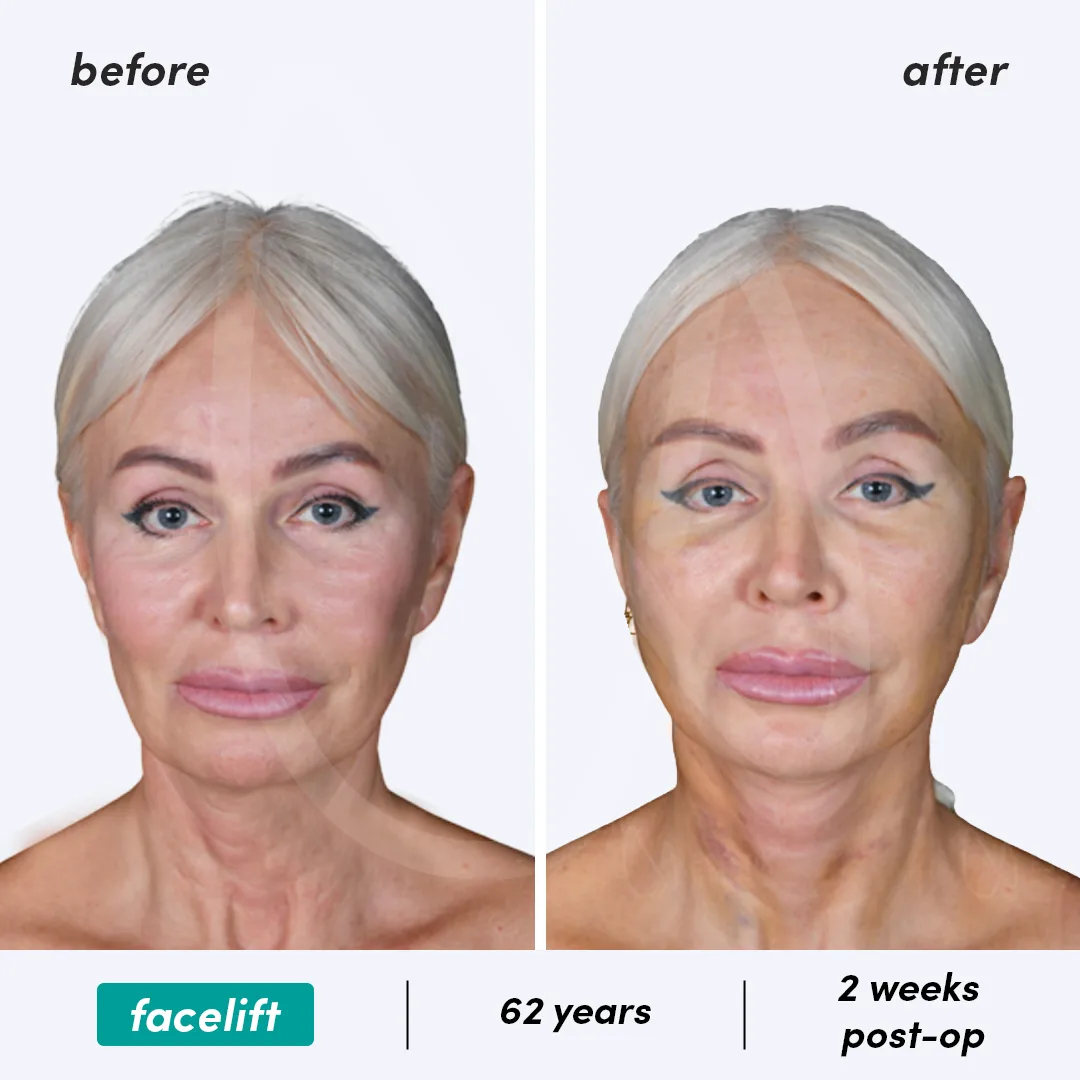 Before-After Combined