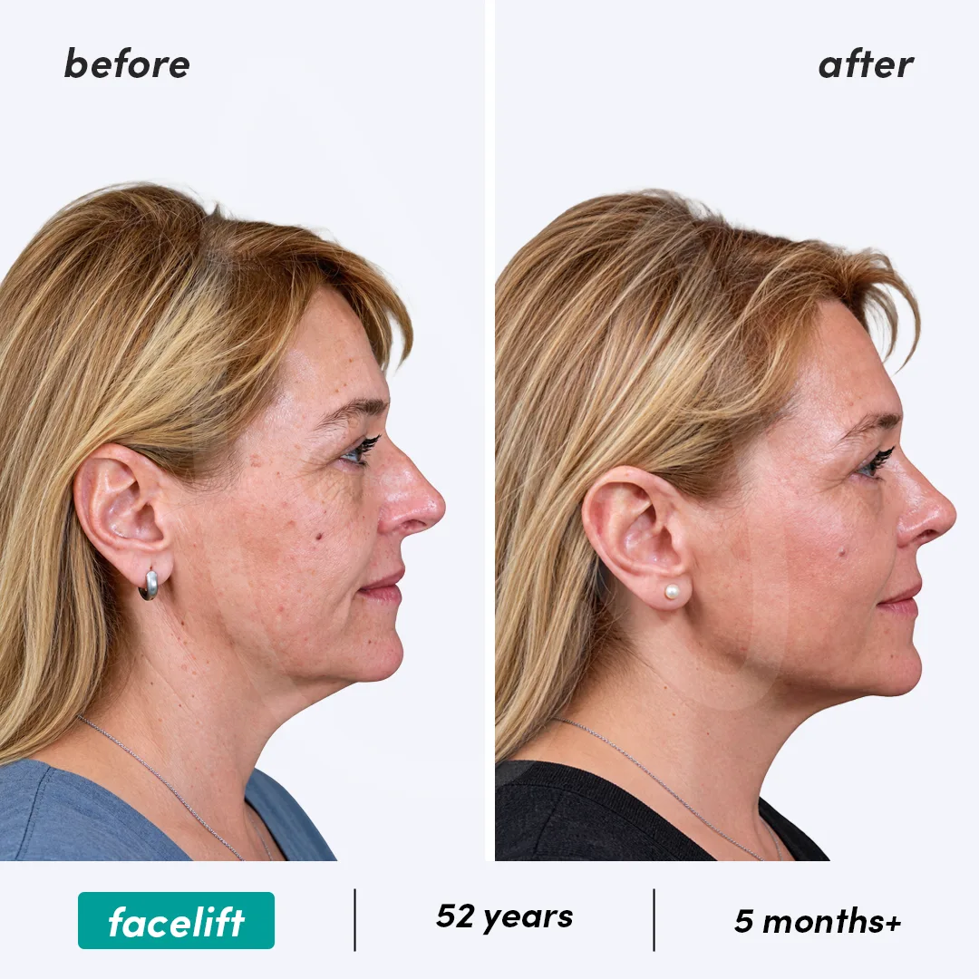Before-After Combined