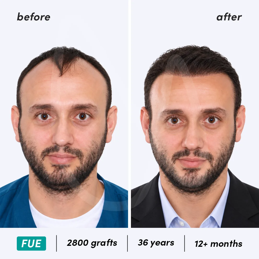Before-After Combined