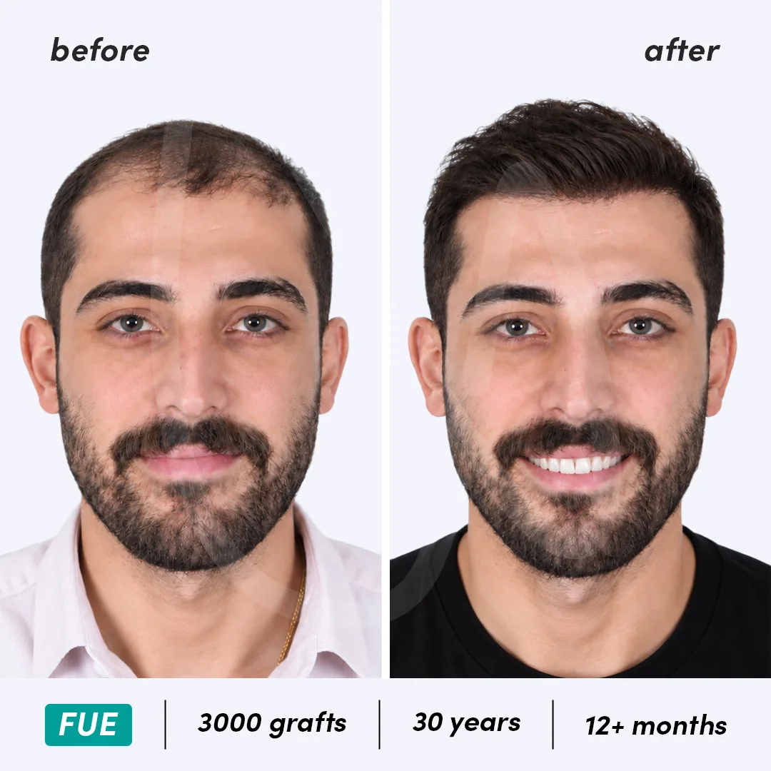 Before-After Combined