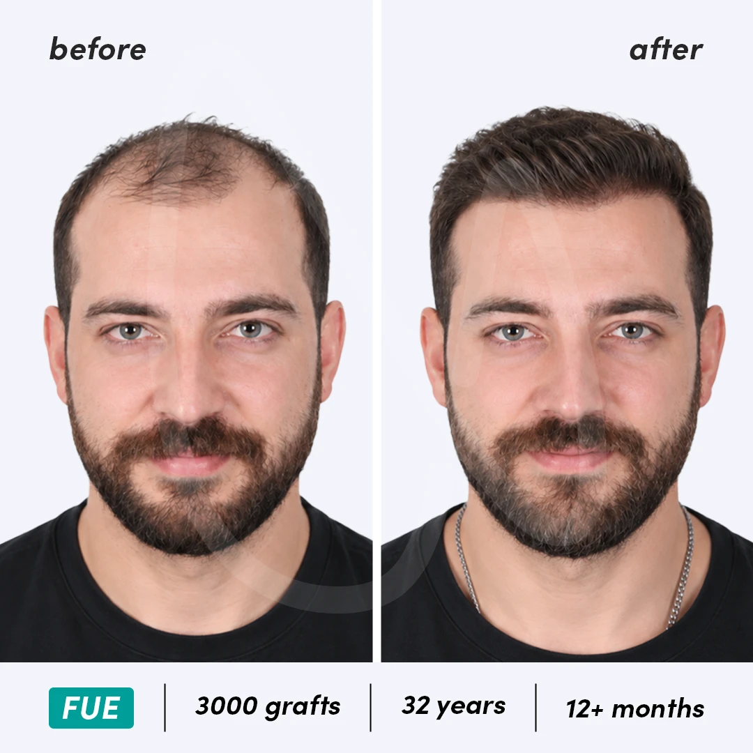 Before-After Combined