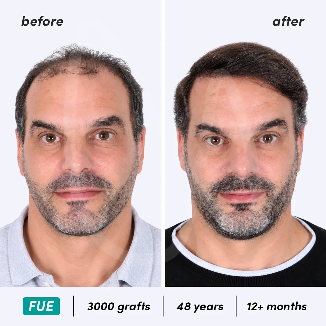 Before-After Combined