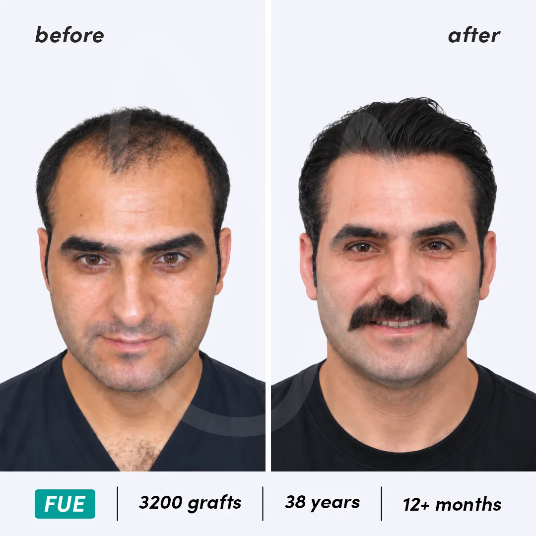 Before-After Combined