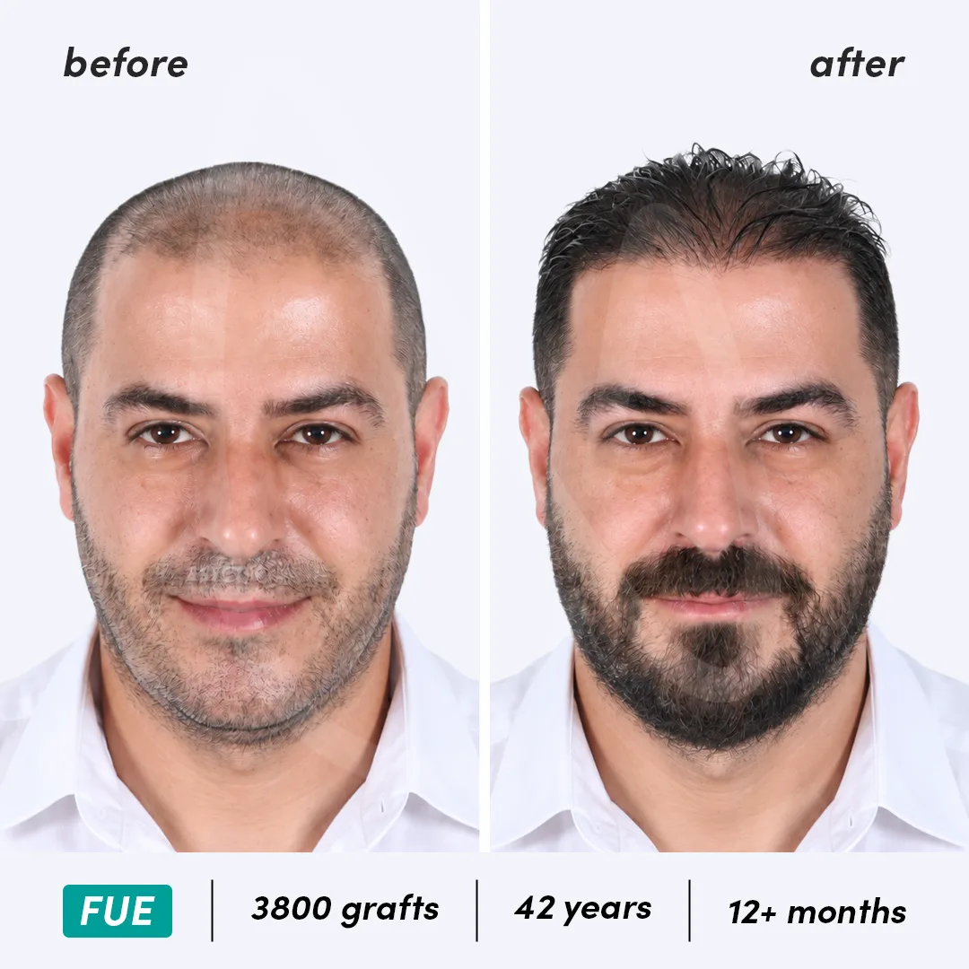 Before-After Combined