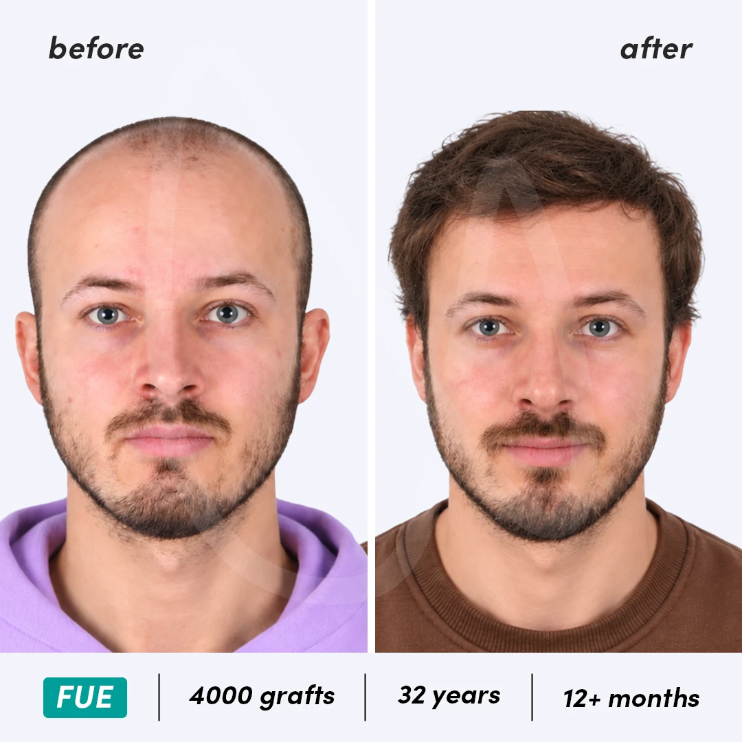 Before-After Combined
