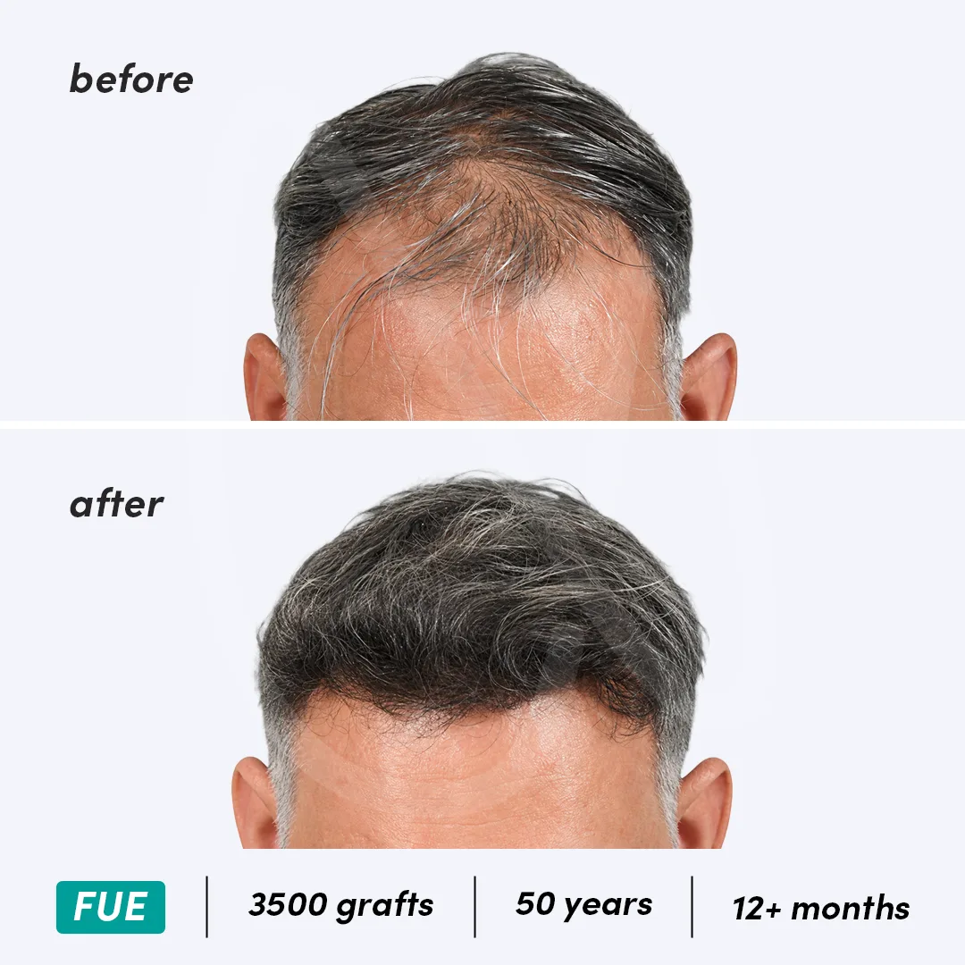 Before-After Combined