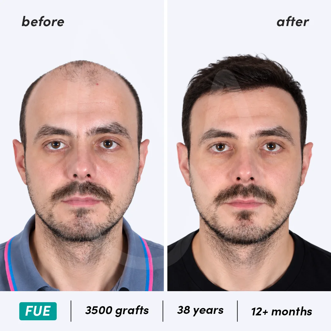 Before-After Combined