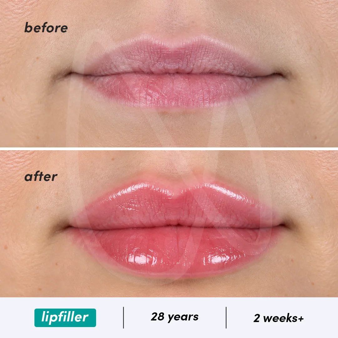 Before-After Combined