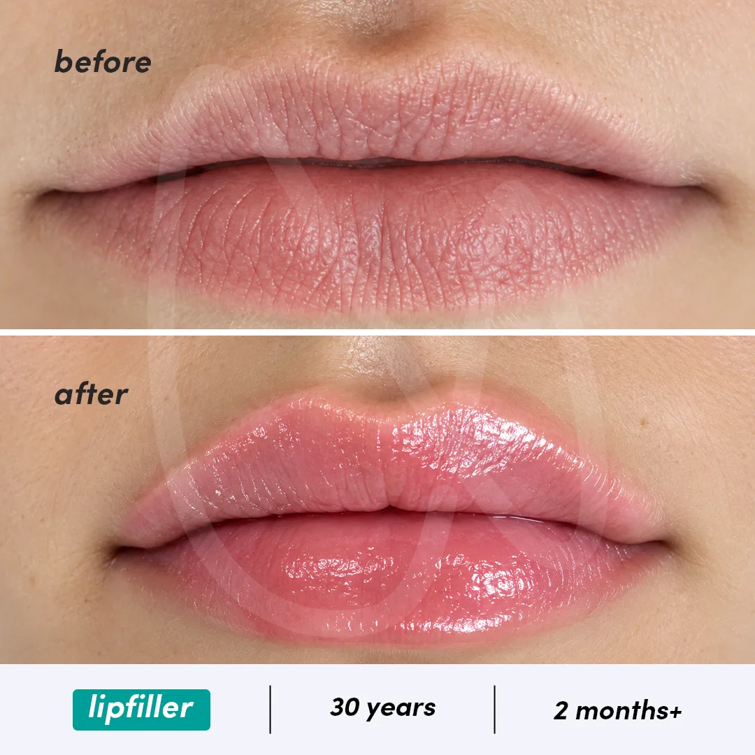 Before-After Combined