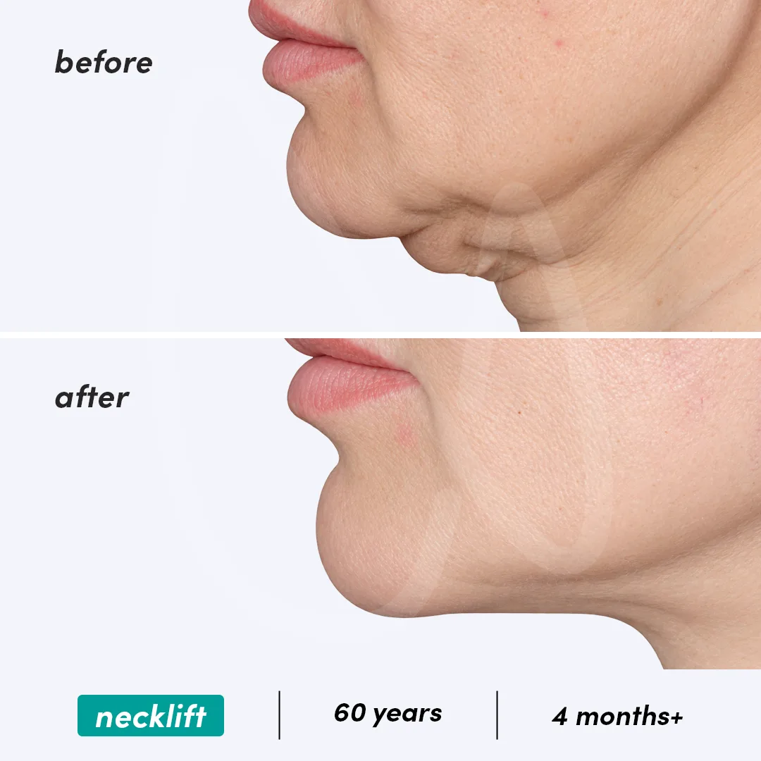 Before-After Combined
