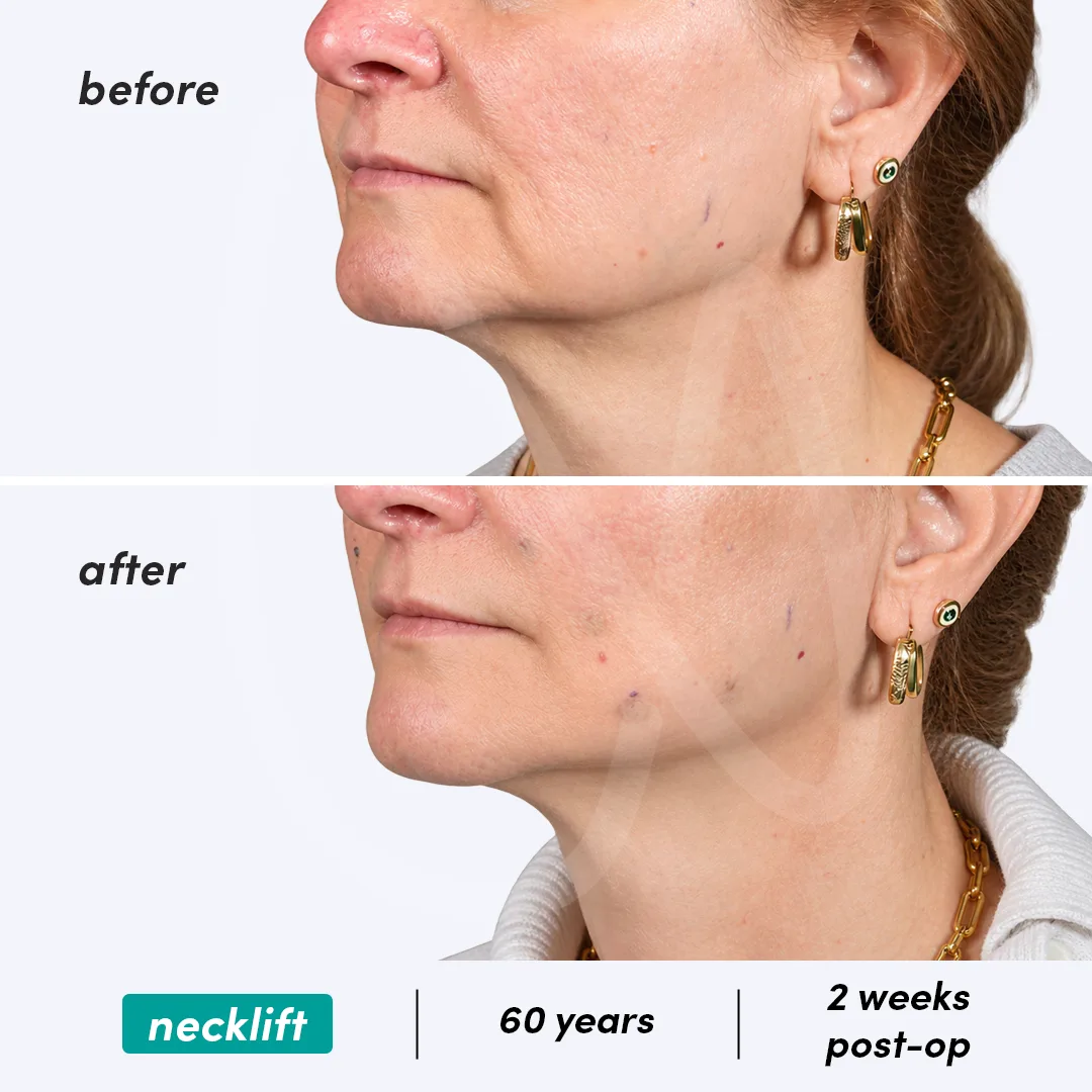 Before-After Combined