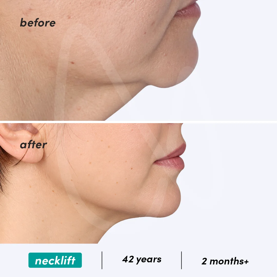 Before-After Combined