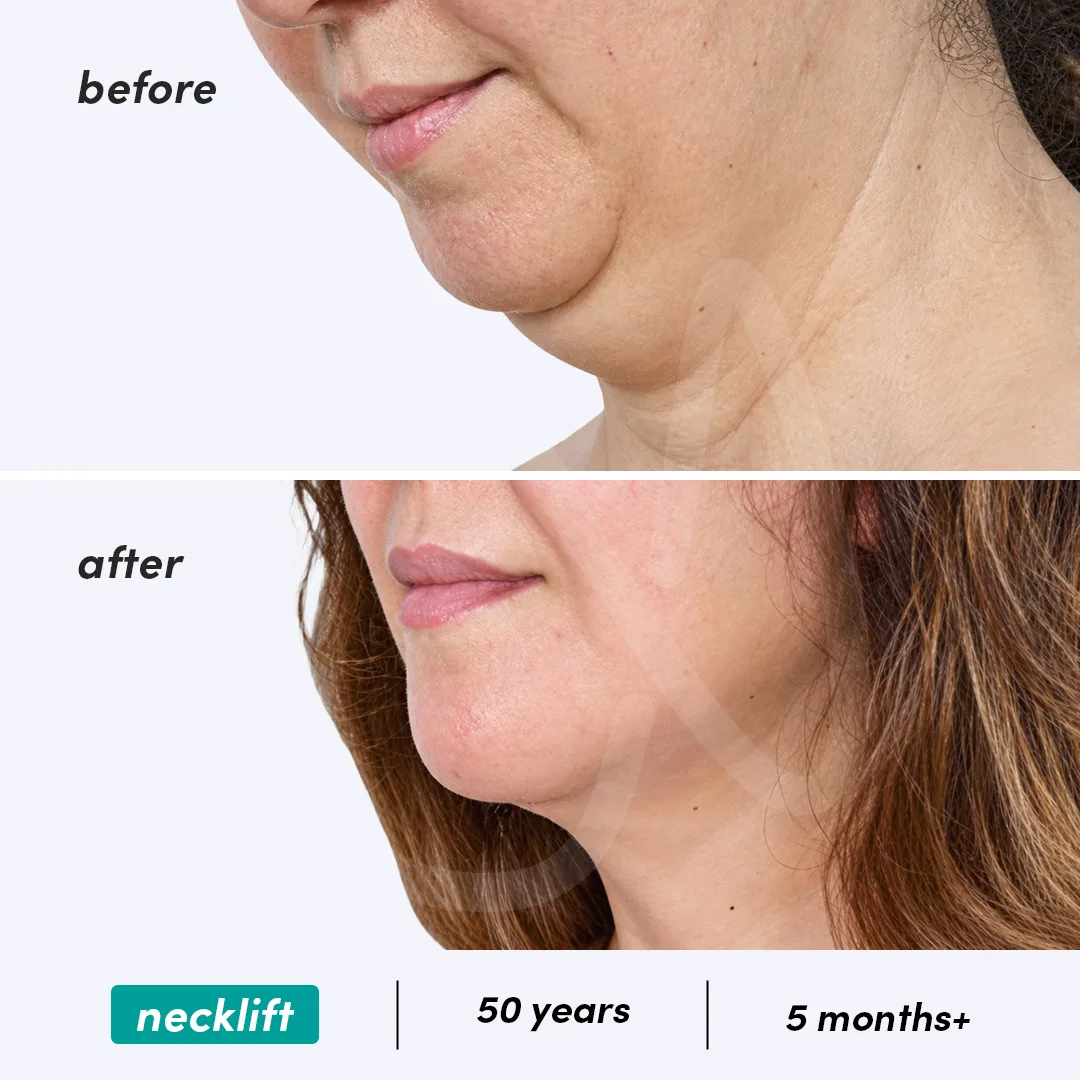 Before-After Combined
