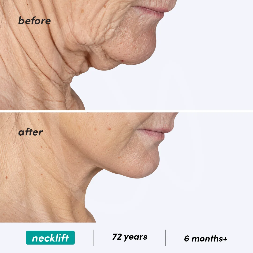 Before-After Combined