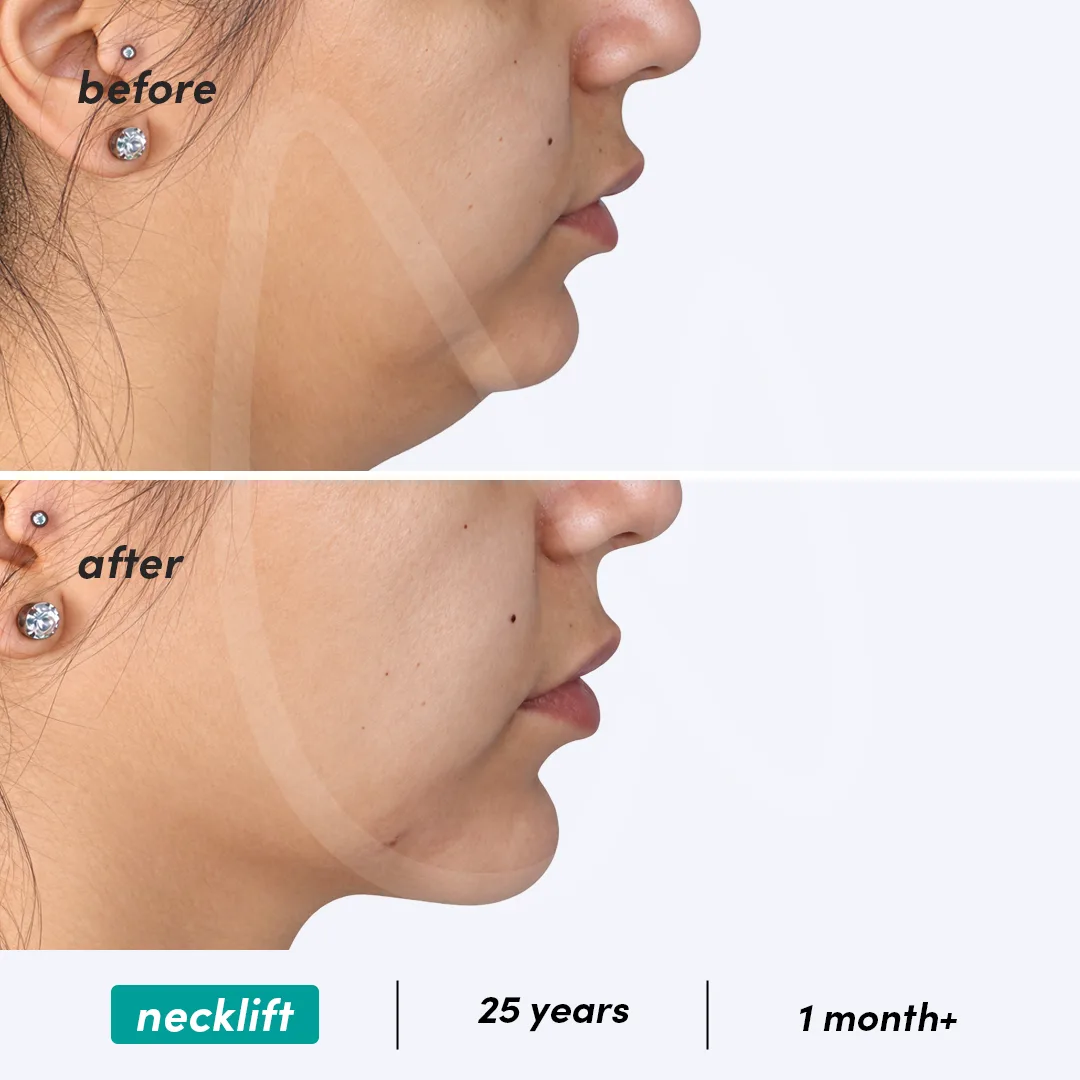Before-After Combined