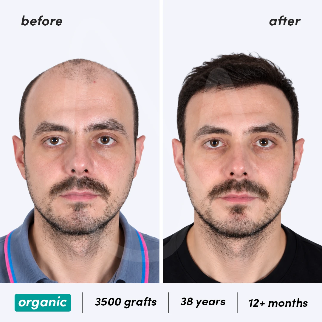 Organic Hair Transplantation – Before After 9