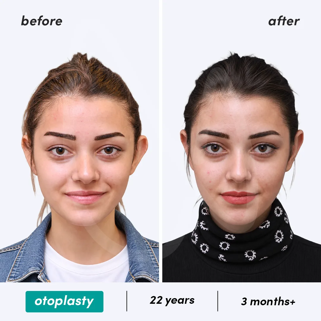 Before-After Combined