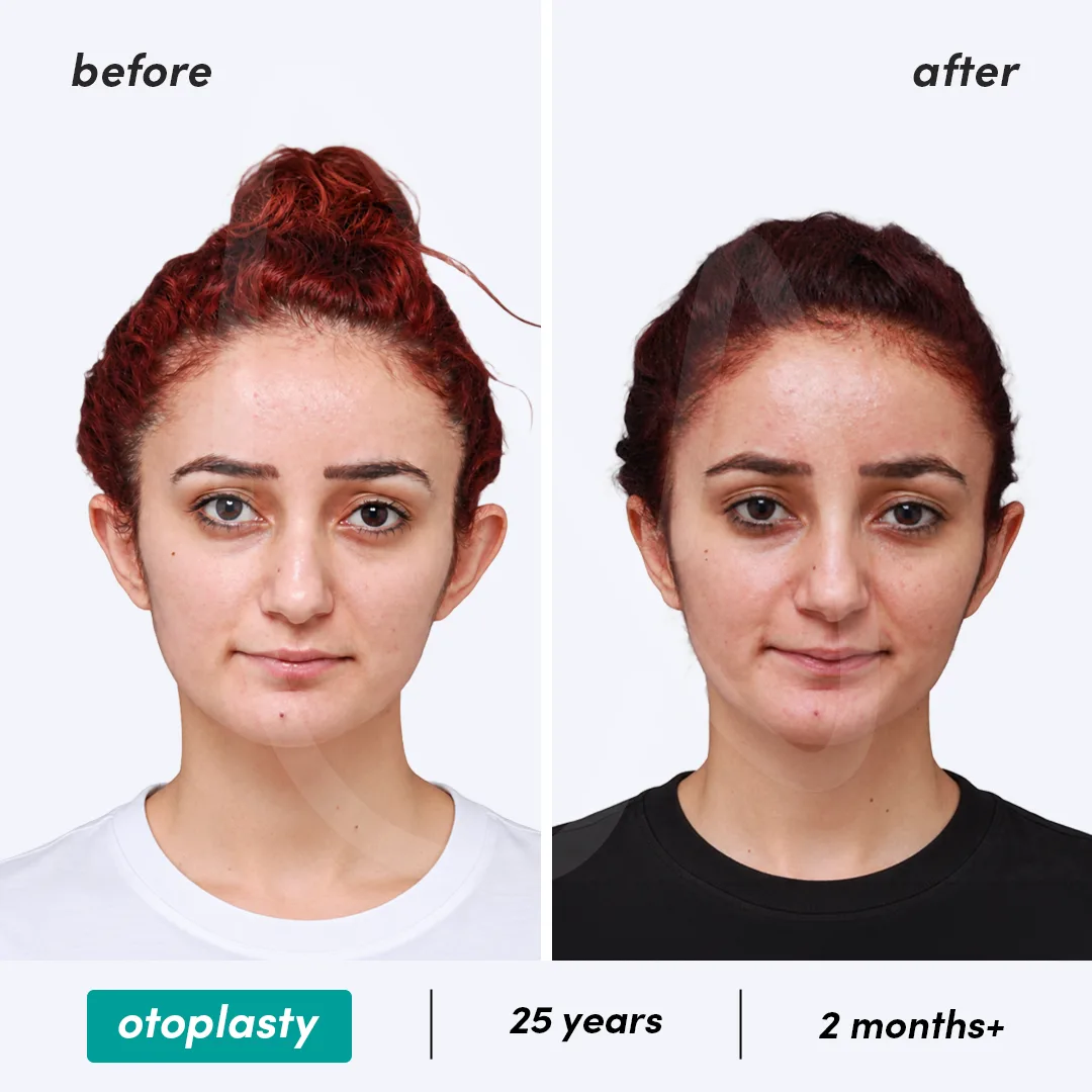 Before-After Combined