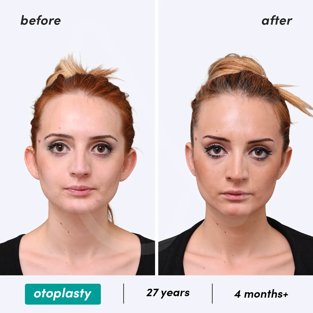 Before-After Combined