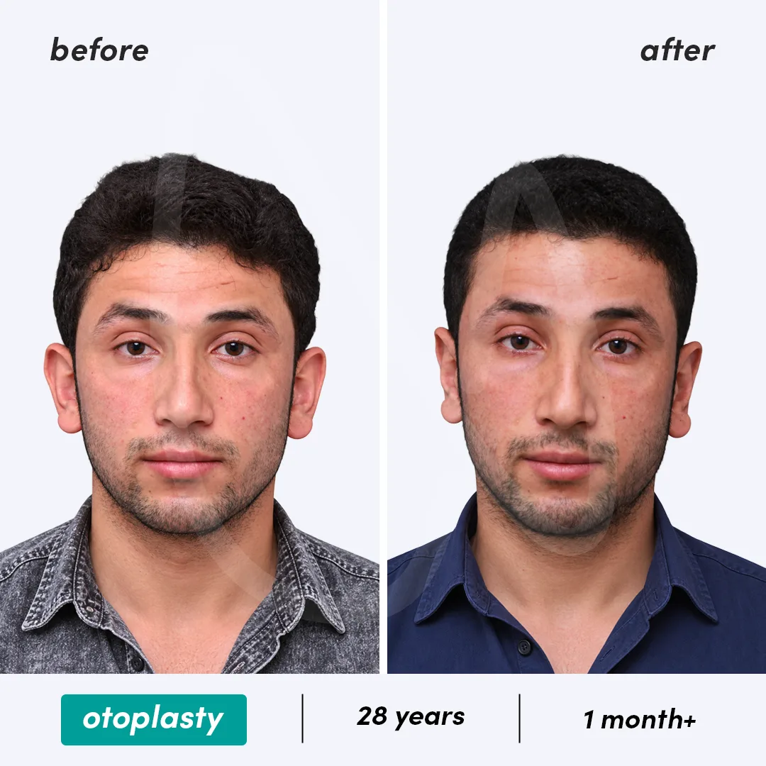 Before-After Combined