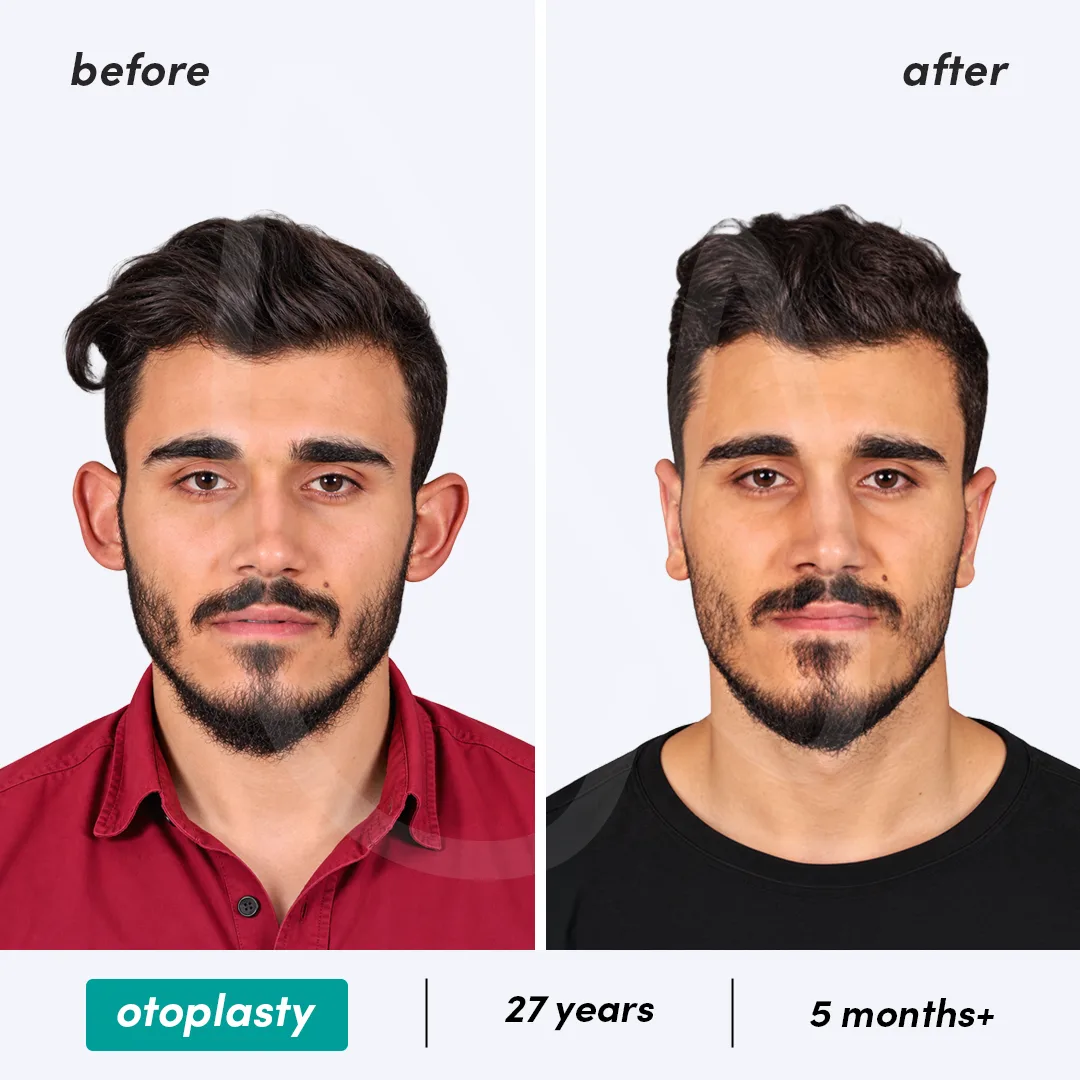 Before-After Combined