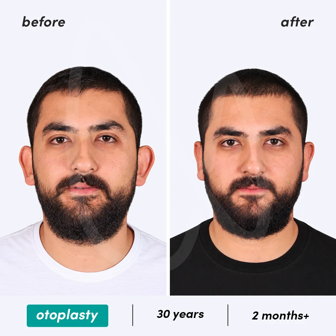 Before-After Combined