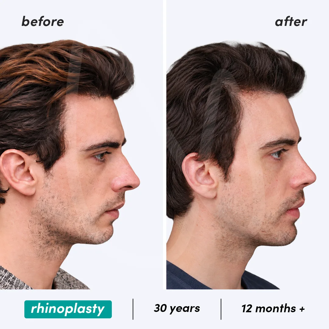 Before-After Combined