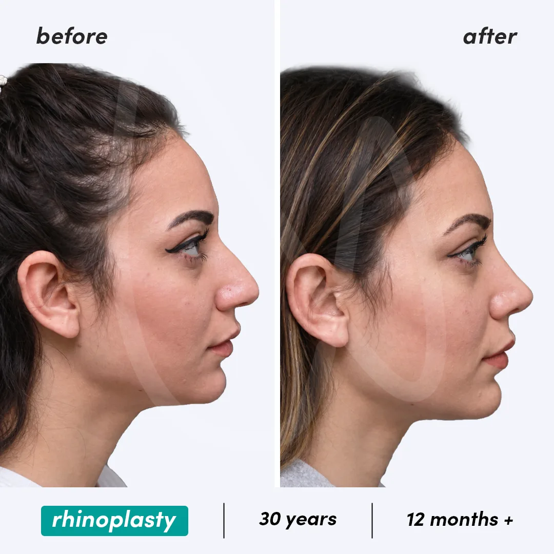 Before-After Combined