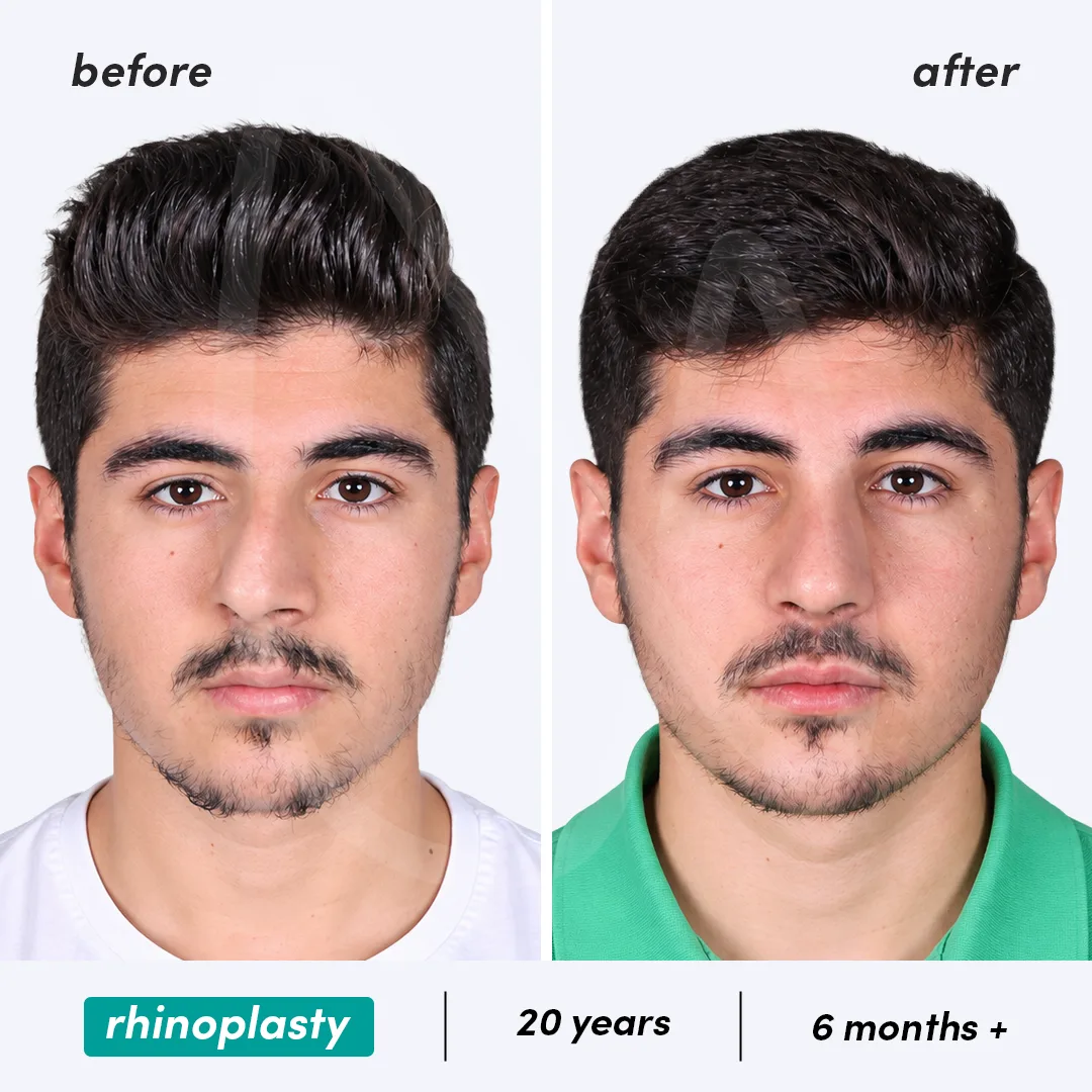 Before-After Combined