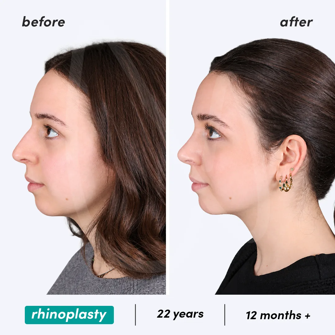 Before-After Combined
