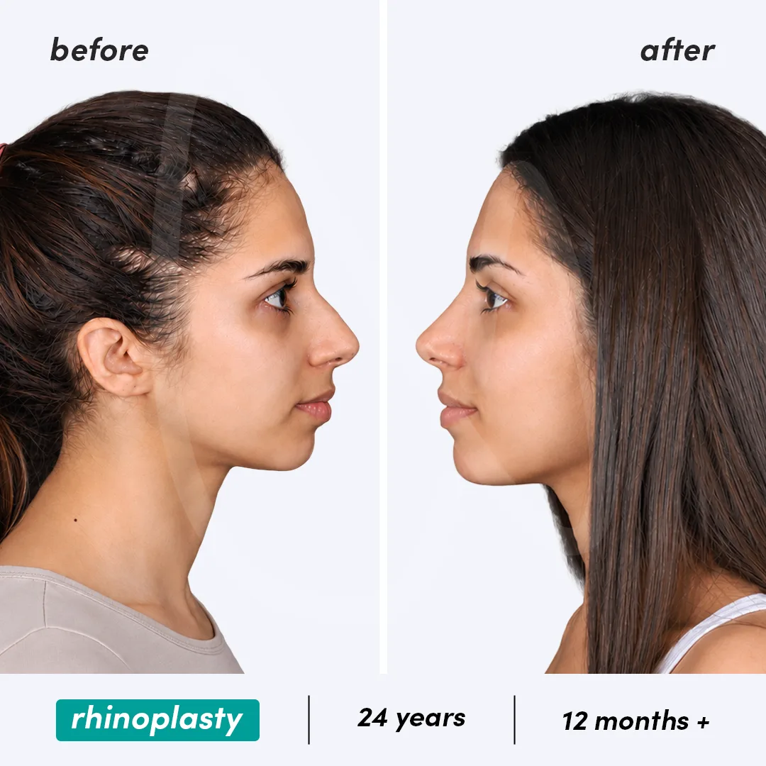 Before-After Combined