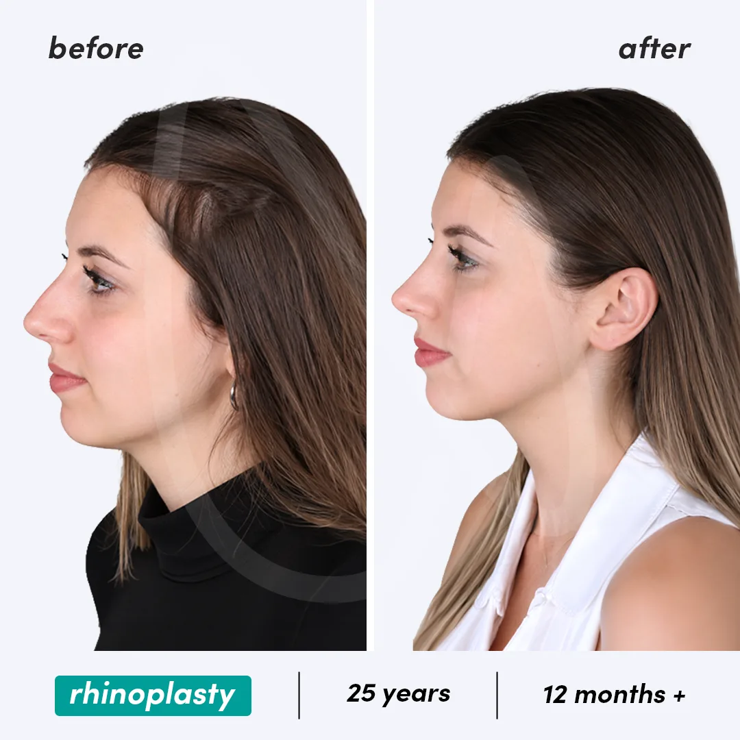 Before-After Combined