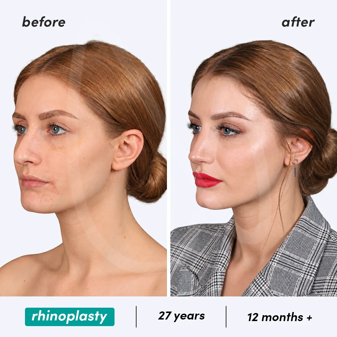 Before-After Combined
