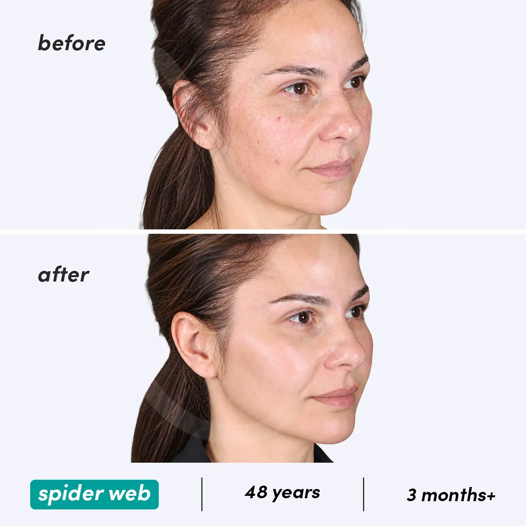 Before-After Combined