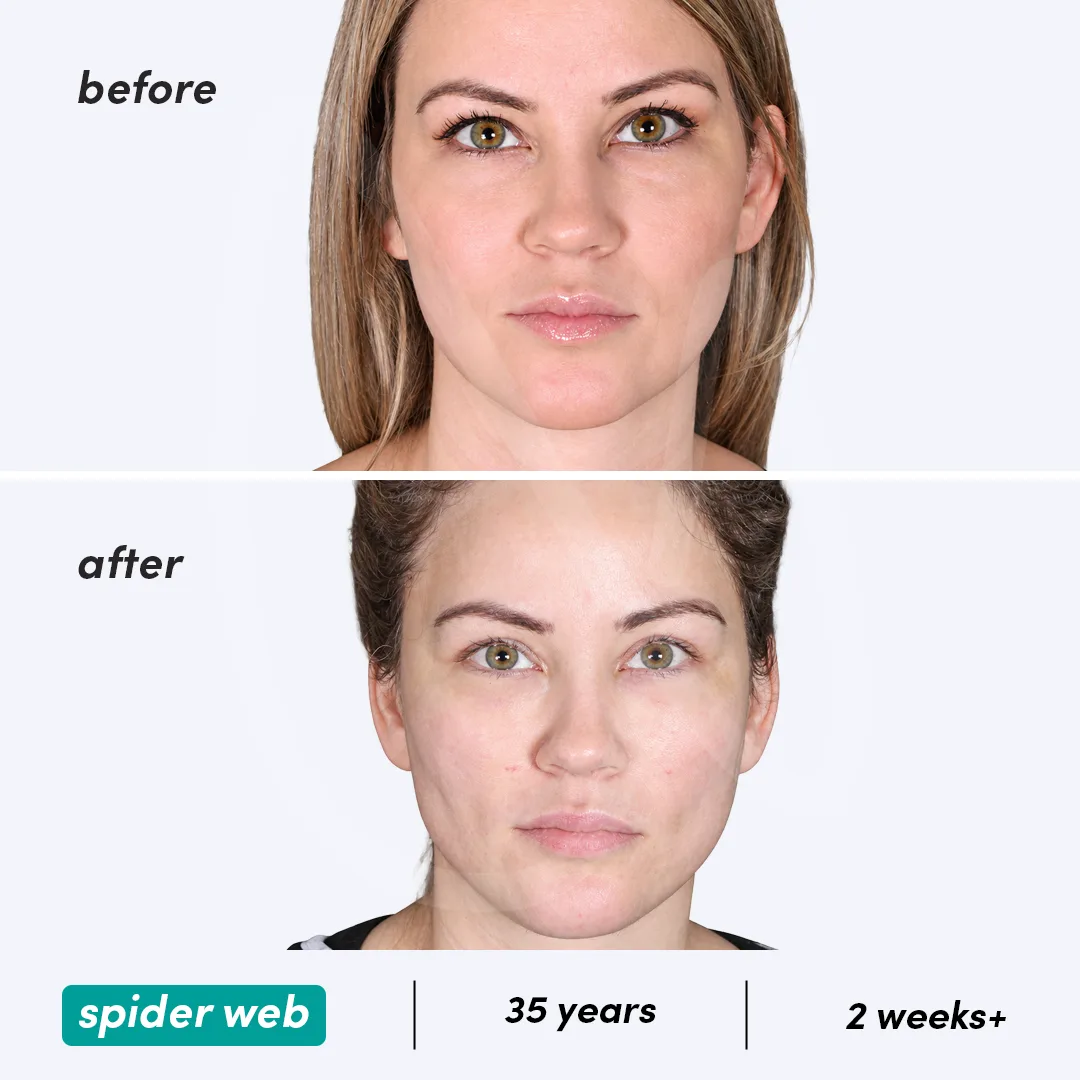 Before-After Combined