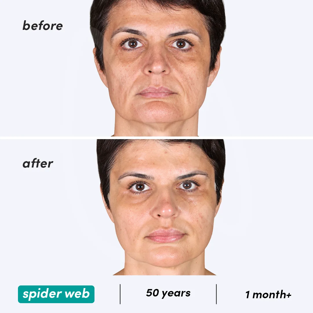 Before-After Combined